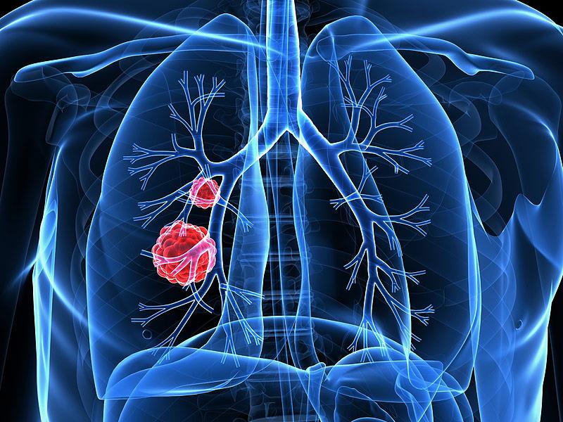 Lung cancer common in JK as cancer on rise
